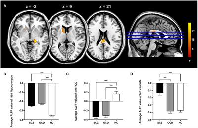 Altered Resting-State Brain Activity in Schizophrenia and Obsessive-Compulsive Disorder Compared With Non-psychiatric Controls: Commonalities and Distinctions Across Disorders